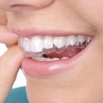 Layanan KLAR Aligners | Spesialis Gigi dan Mulut Klinik Utama Pandawa